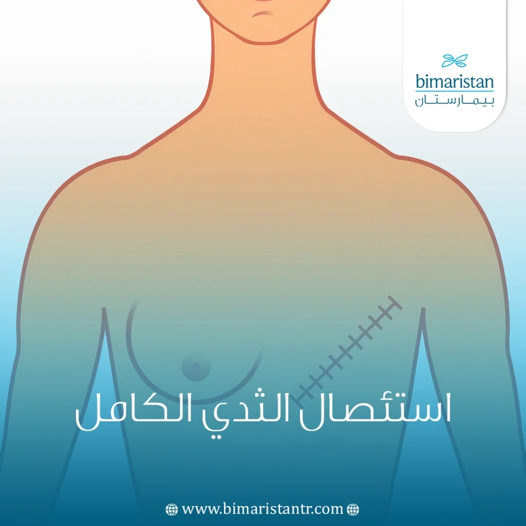 استئصال الثدي الكامل
