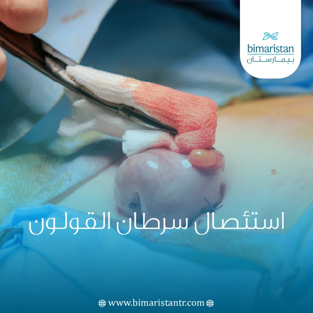 استئصال سرطان القولون