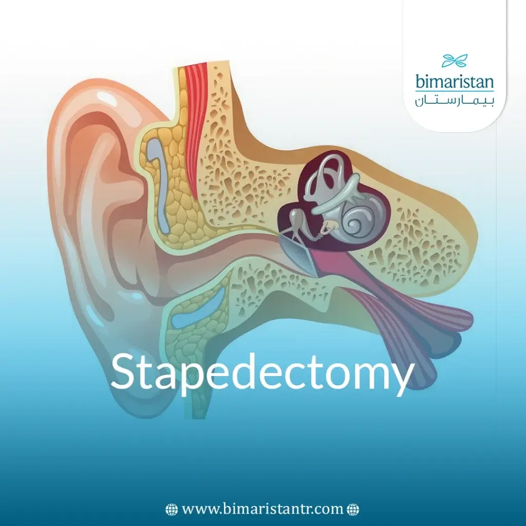 Stapedectomy: Surgery To Restore Hearing In Otosclerosis
