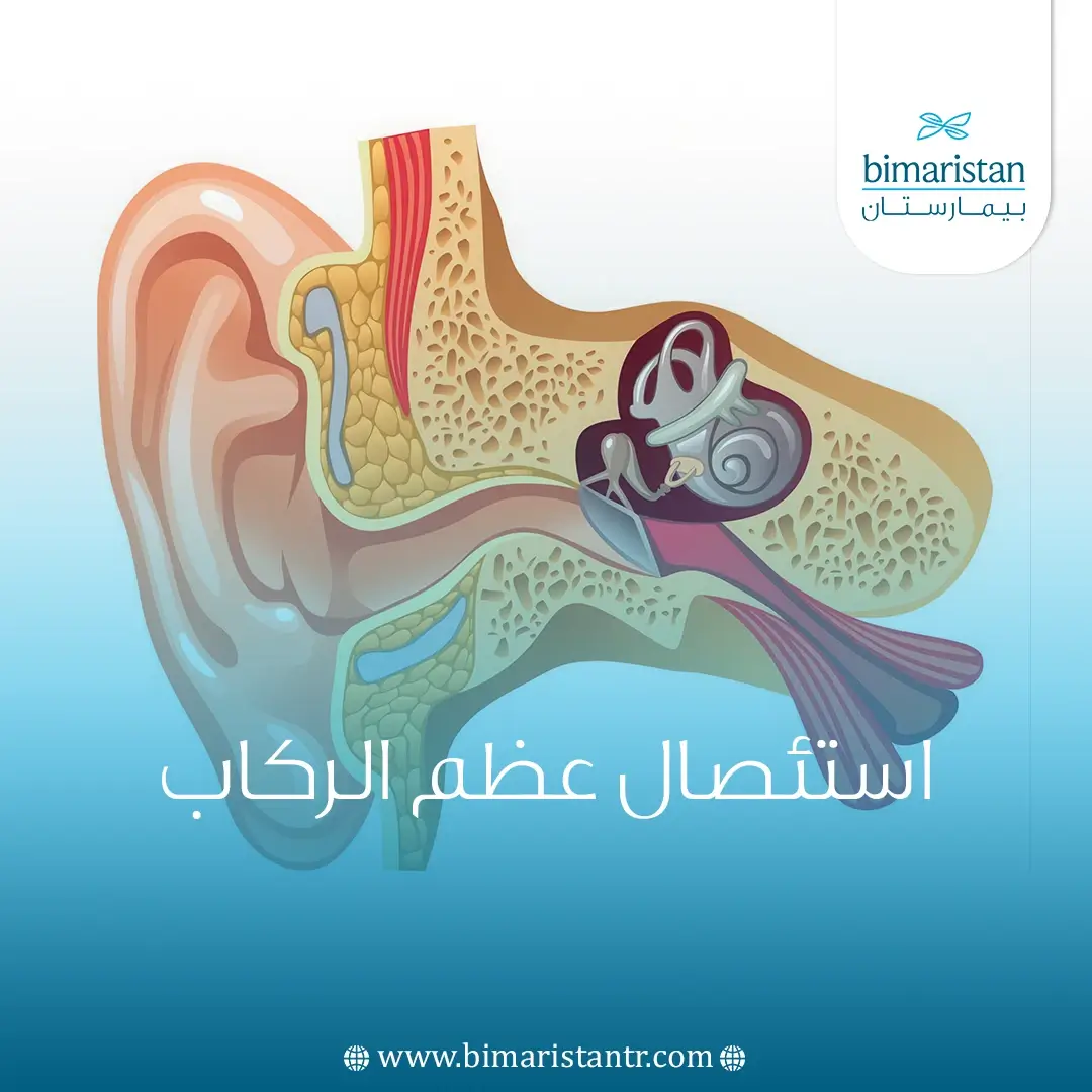 استئصال عظم الركاب