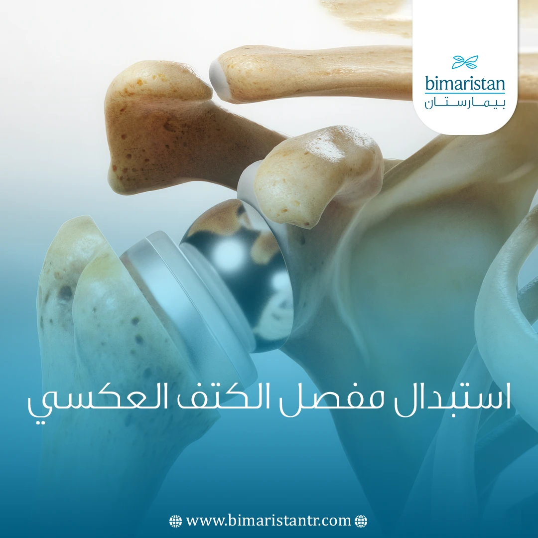 استبدال مفصل الكتف العكسي
