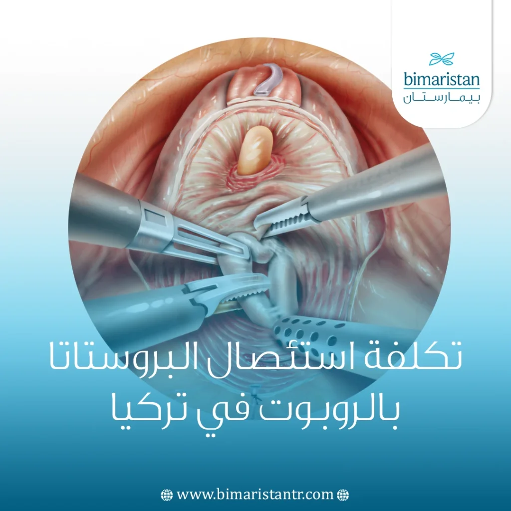تكلفة استئصال البروستاتا بالروبوت في تركيا