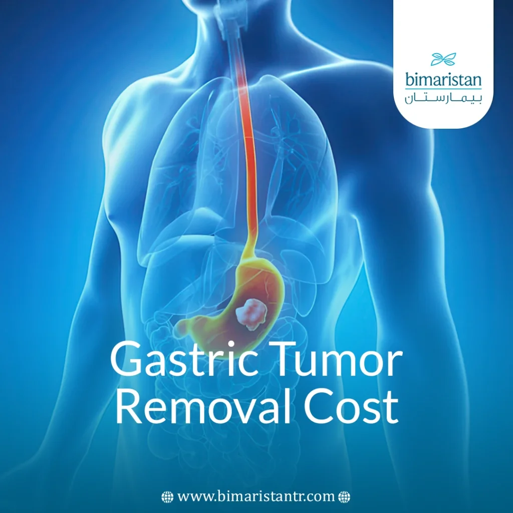 Gastric Tumor Removal Cost: Key Factors &Amp; Patient Guide