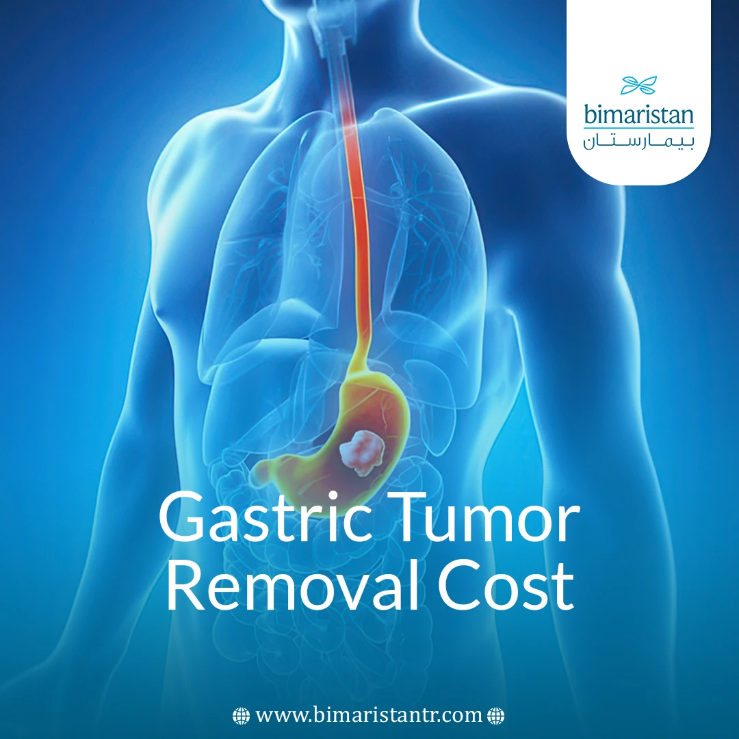 Gastric Tumor Removal Cost: Key Factors &Amp;Amp; Patient Guide