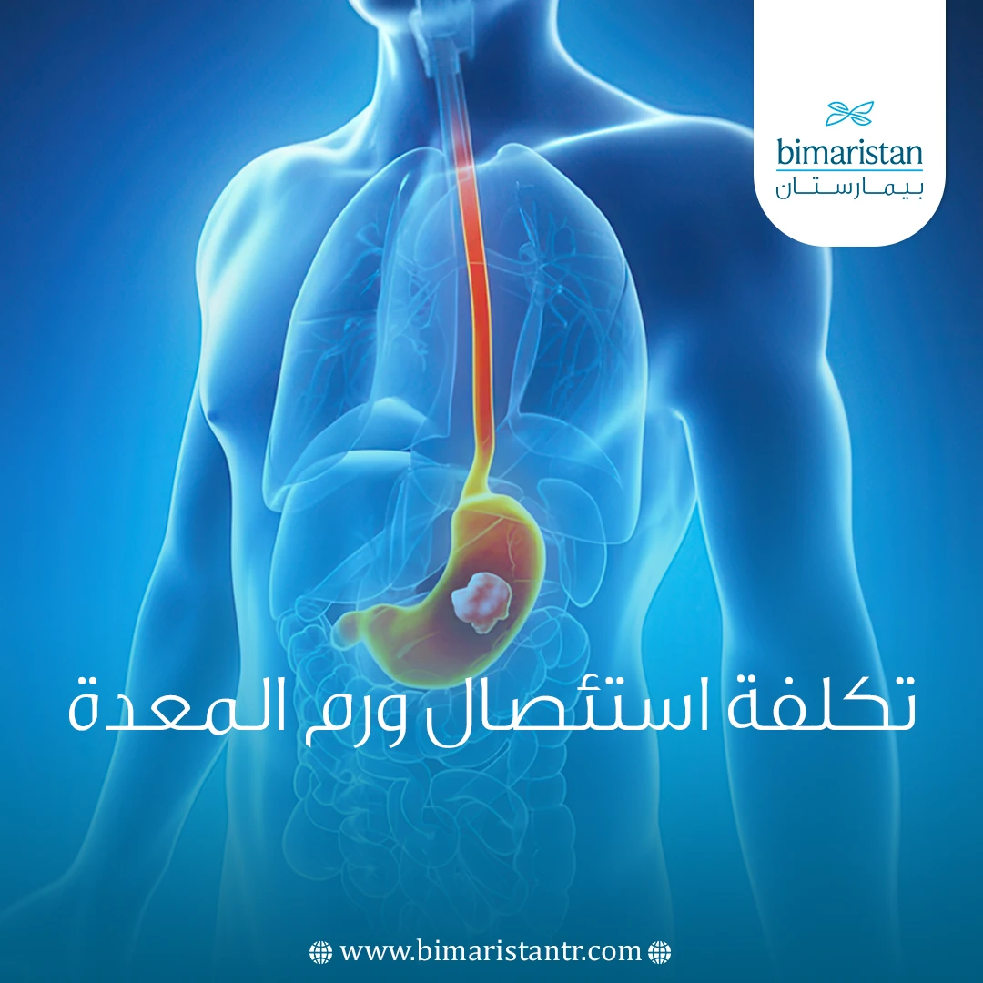 تكلفة استئصال ورم المعدة