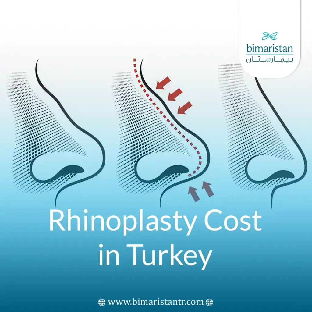 Rhinoplasty Cost In Turkey: Key Facts Before Your Surgery