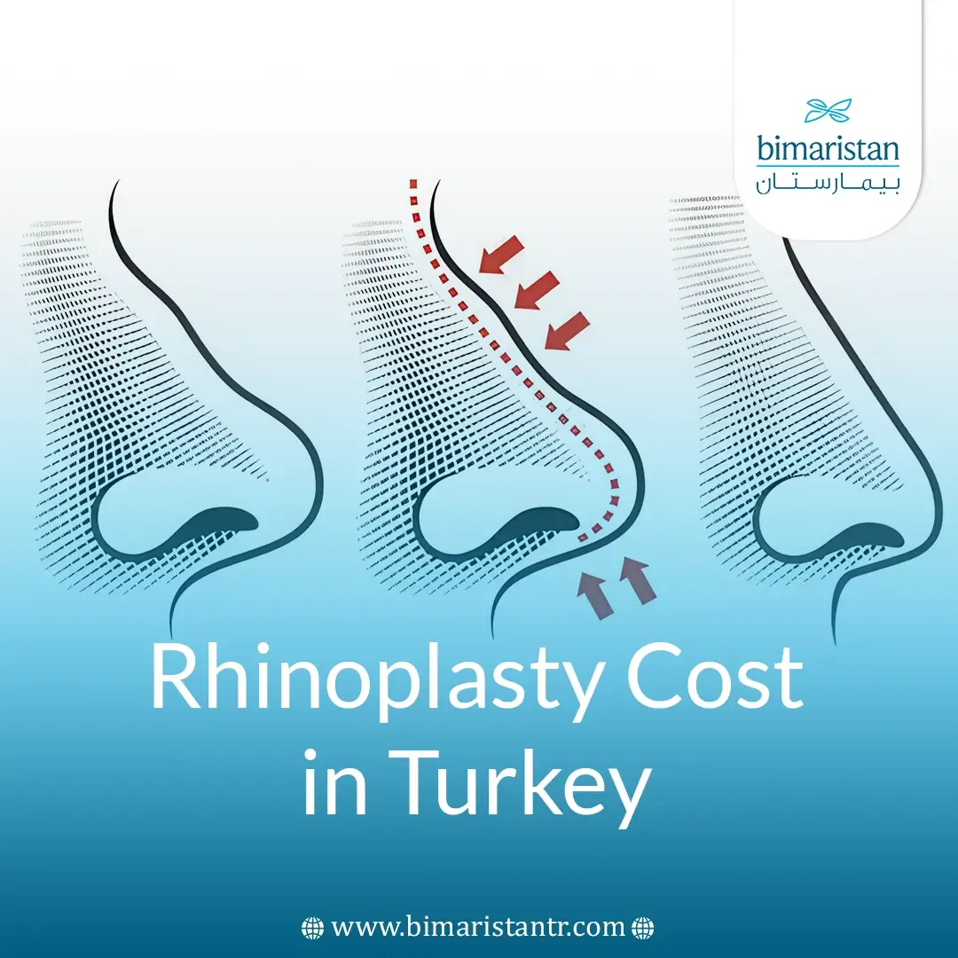 Rhinoplasty Cost In Turkey: What To Know Before Your Nose Surgery
