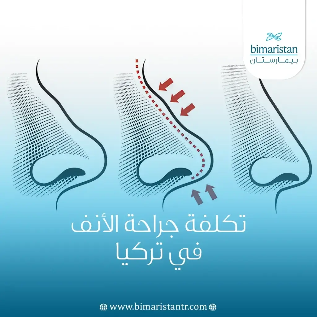 تكلفة جراحة الأنف في تركيا