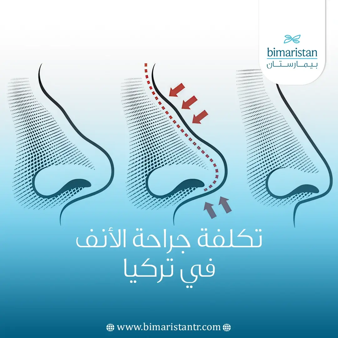 تبحث عن التغيير؟ تعرف على تكلفة جراحة الأنف في تركيا قبل أن تخطو
