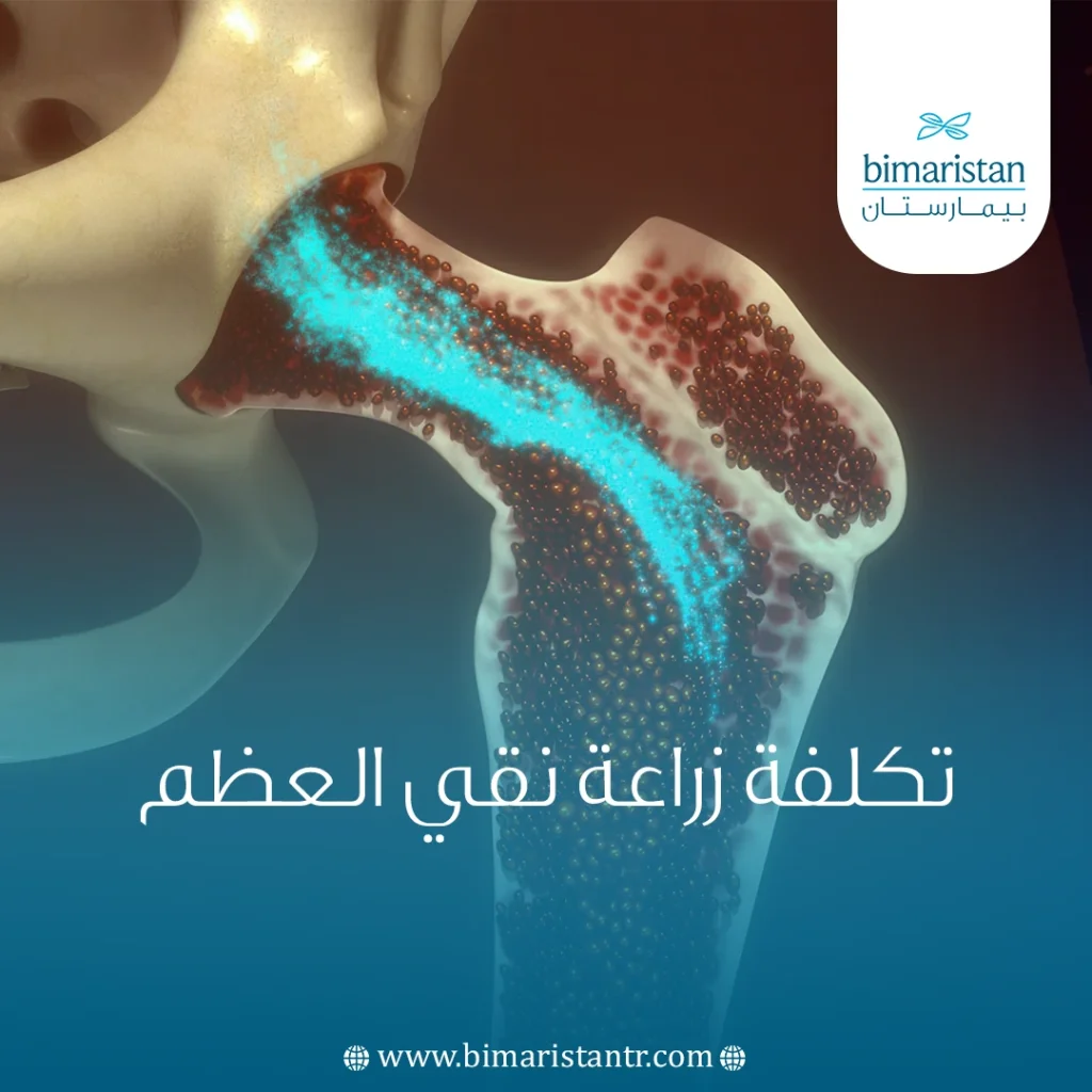 تكلفة زراعة نقي العظم