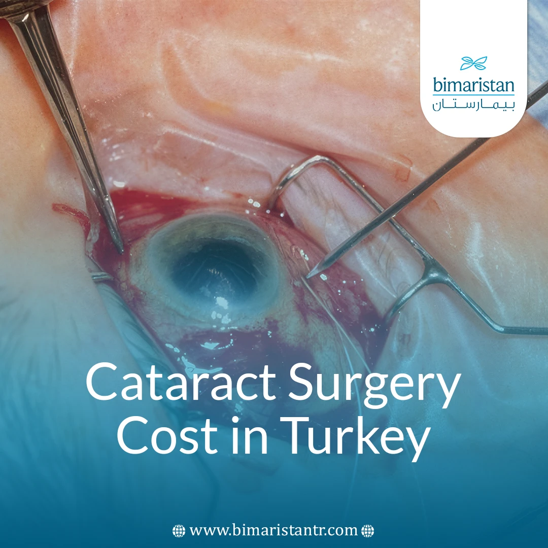 Cataract Surgery Cost In Turkey: Quality At Affordable Prices