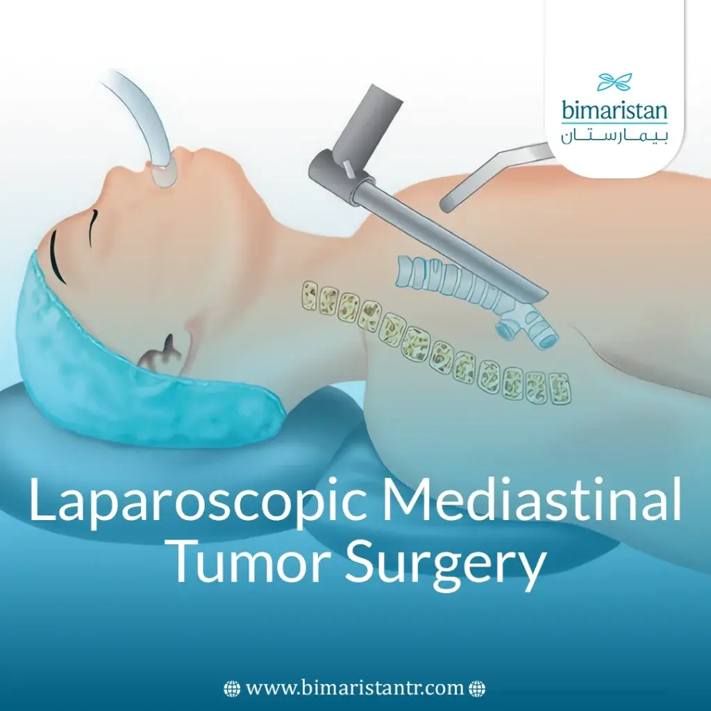 Laparoscopic Mediastinal Tumor Surgery: Safe, Precise Care