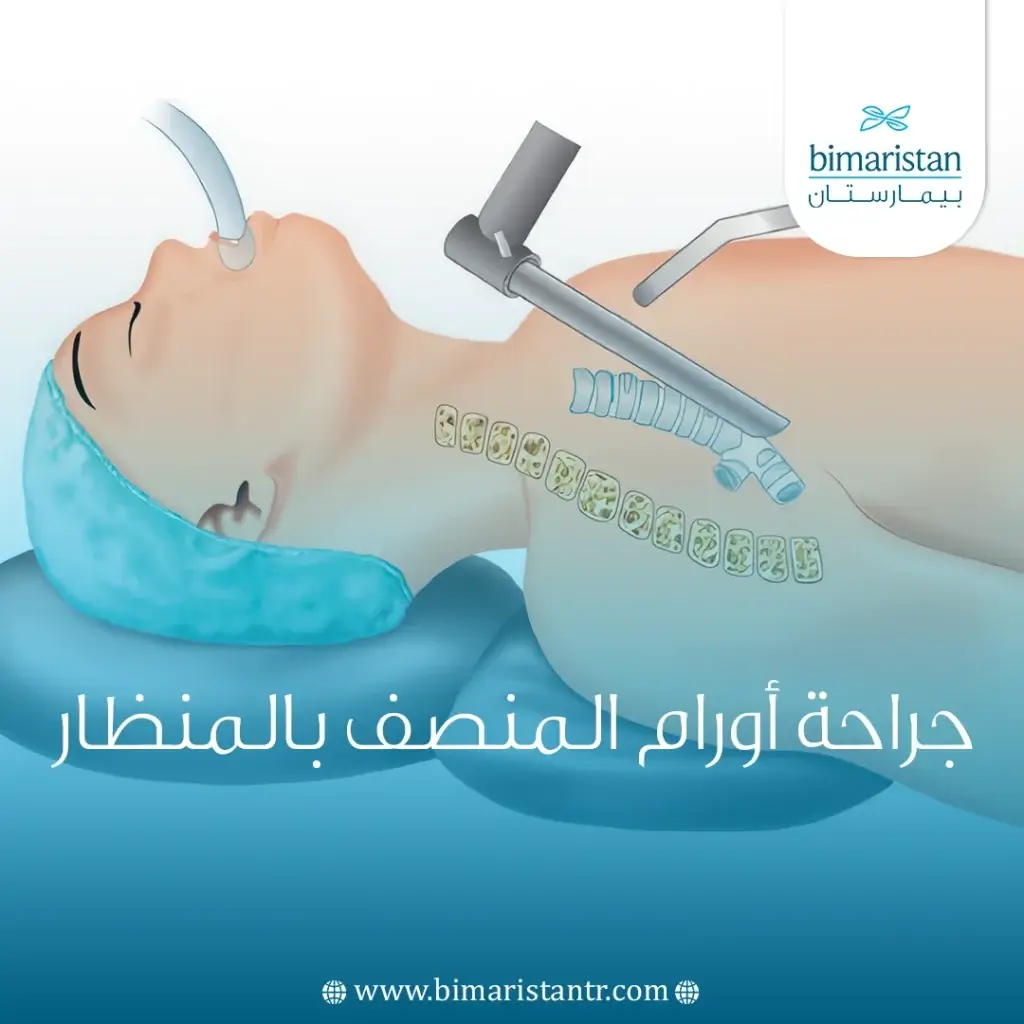جراحة أورام المنصف بالمنظار