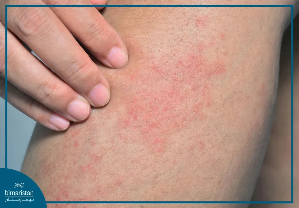 Advanced Prostate Cancer Symptoms: Key Signs To Watch For 2 Advanced Prostate Cancer Symptoms: Skin Rash Is An Advanced Prostate Cancer Symptom