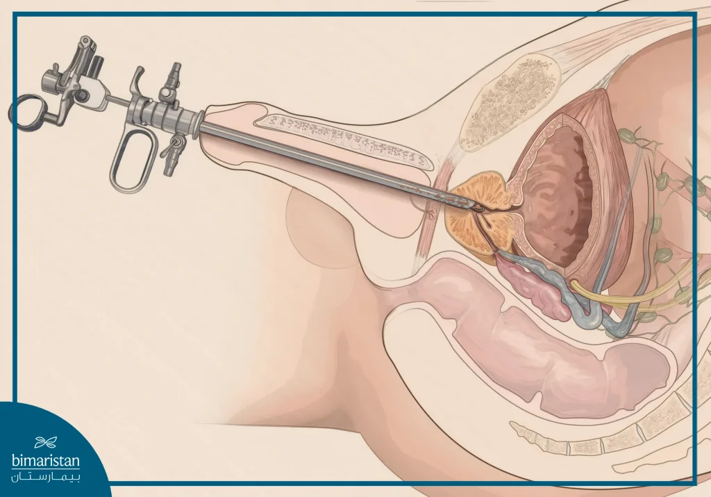 عملية استئصال البروستاتا عبر الإحليل (Turp) 
