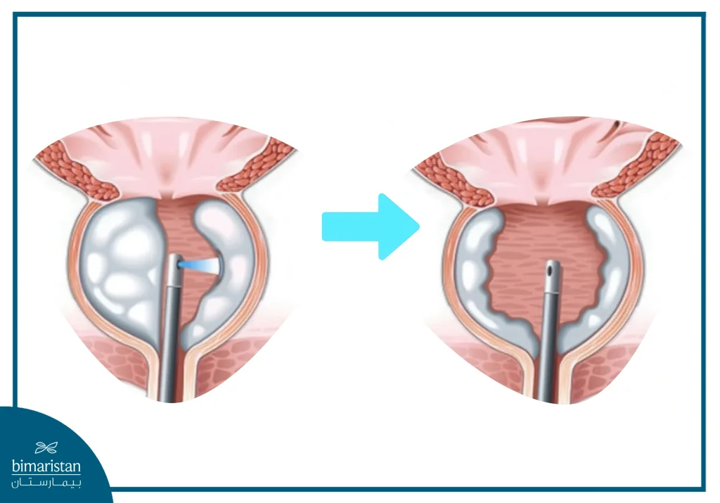 علاج تضخم البروستاتا بالليزر (Holep)