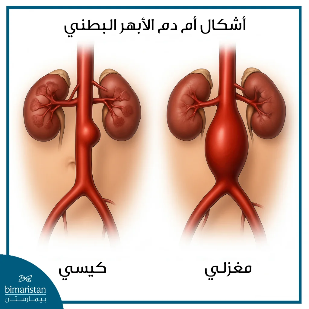 أم دم الأبهر البطني 3 صورة توضح أشكال أم دم الأبهر البطني
