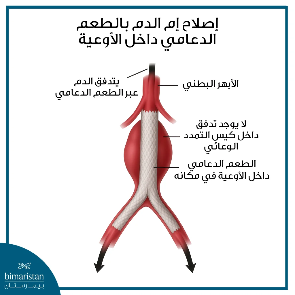 أم دم الأبهر البطني 5 صورة توضح إصلاح أم دم الأبهر البطني داخل الأوعية