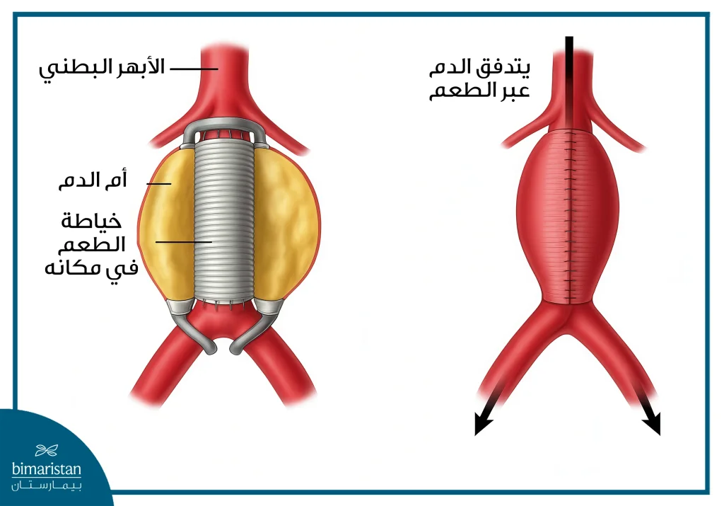 أم دم الأبهر البطني 4 صورة توضح إصلاح أم دم الأبهر البطني عن طريق الجراحة المفتوحة