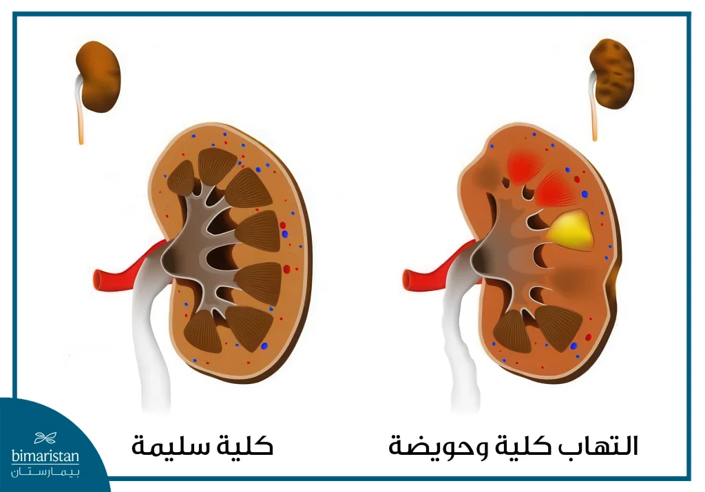 التهاب المسالك البولية عند الرجال: الدليل الشامل 2 الفرق ما بين الكلية السليمة والتهاب الكلية والحويضة