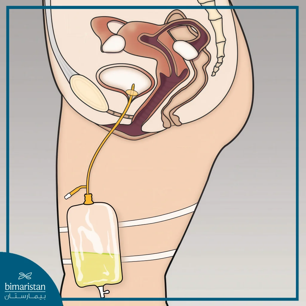 Urinary Catheterization As A Treatment For Urinary Tract Infections In Women