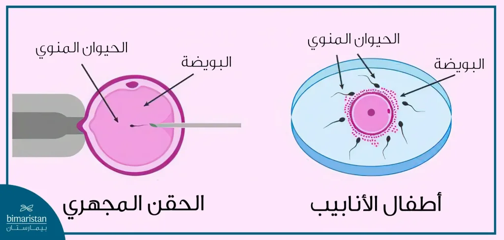 صورة توضح الفرق ما بين آلية أطفال الأنابيب والحقن المجهري