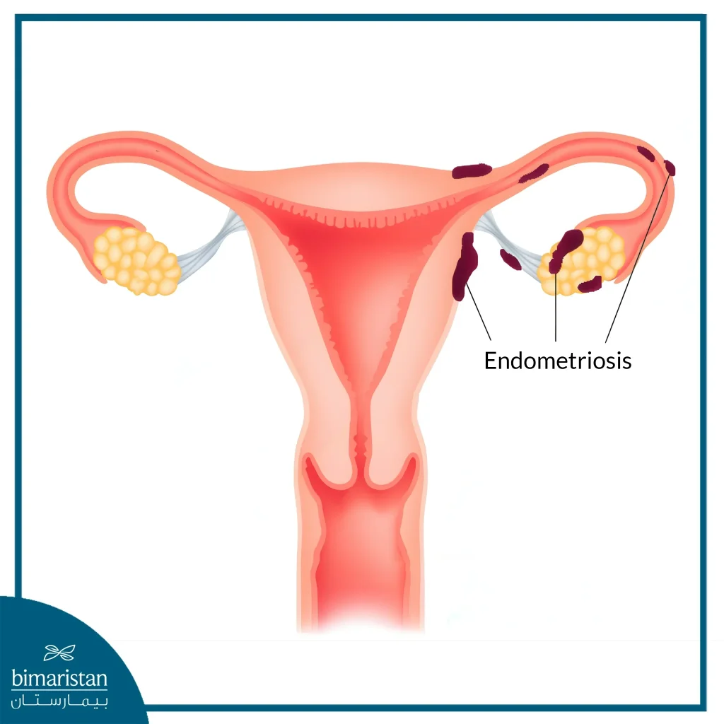 Image Showing The Migrating Endometrium (Endometriosis)