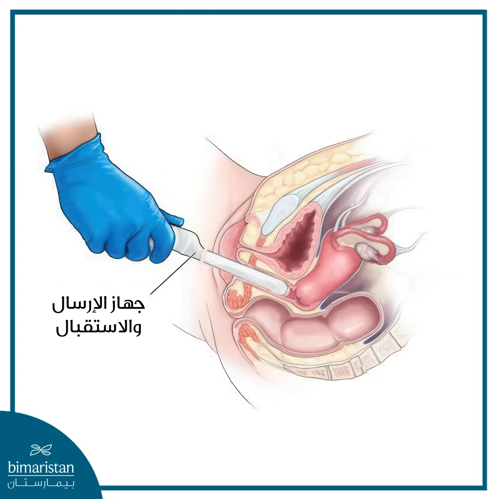 الأمواج فوق الصوتية عبر المهبل لتشخيص العقم والانتباذ البطاني الرحمي