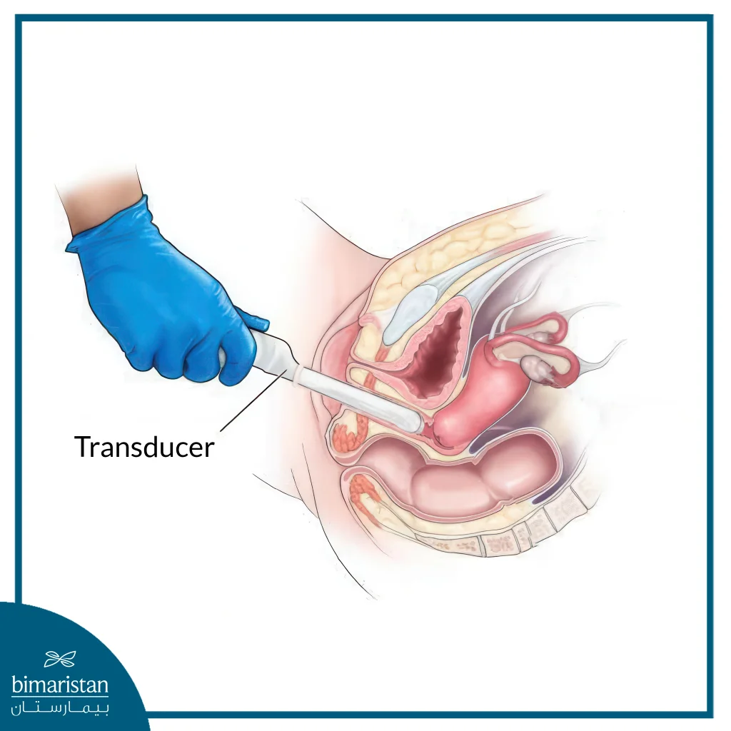 Transvaginal Ultrasound To Diagnose Endometriosis And Infertility