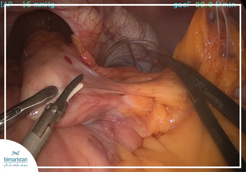 Difference Between Laparoscopic And Open Esophagectomy: Key Points 3 Surgical Image Shows The Difference Between Laparoscopic And Open Esophagectomy, Highlighting The Advanced Laparoscopic Technique For Accurate And Safe Esophageal Surgeries.