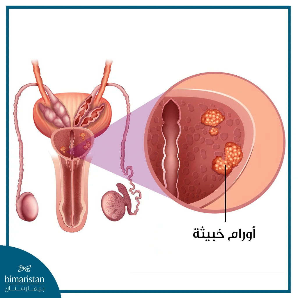 الفرق بين تضخم البروستاتا وسرطان البروستاتا 3 الفرق بين تضخم البروستاتا وسرطان البروستاتا هو وجود الأورام الخبيثة في حالة السرطان