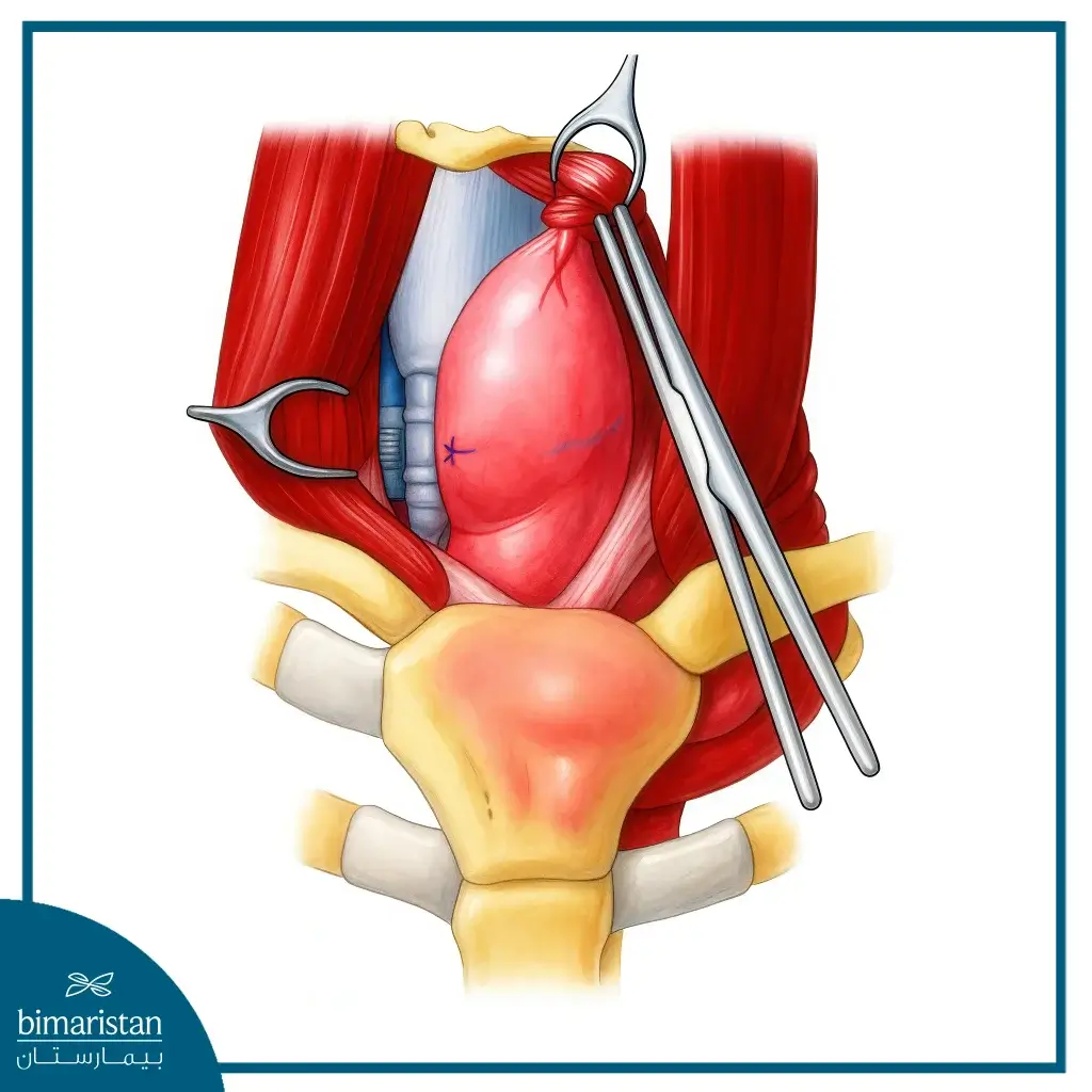 Weight After Thyroidectomy