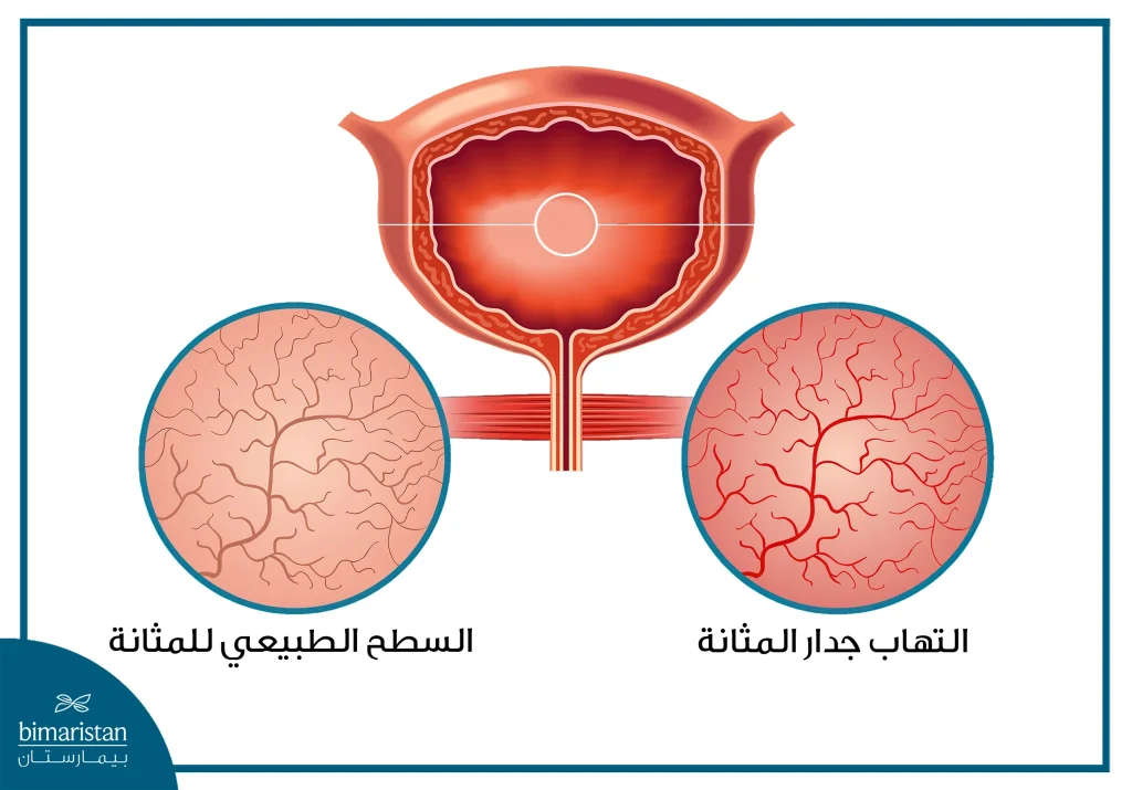 التهاب جدار المثانة الذي يسبب تأثير التهاب المثانة على الخصوبة