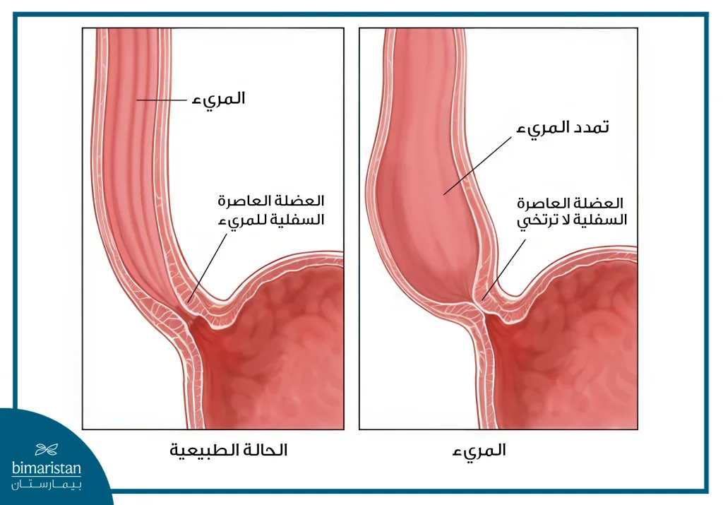 صورة توضح الفرق بين تعذر ارتخاء المريء والحالة الطبيعية