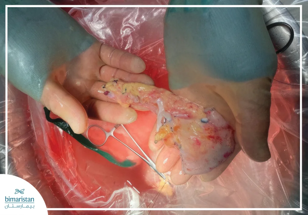 Image Showing The Shape Of The Pancreas For Pancreas Transplant Cost In Turkey