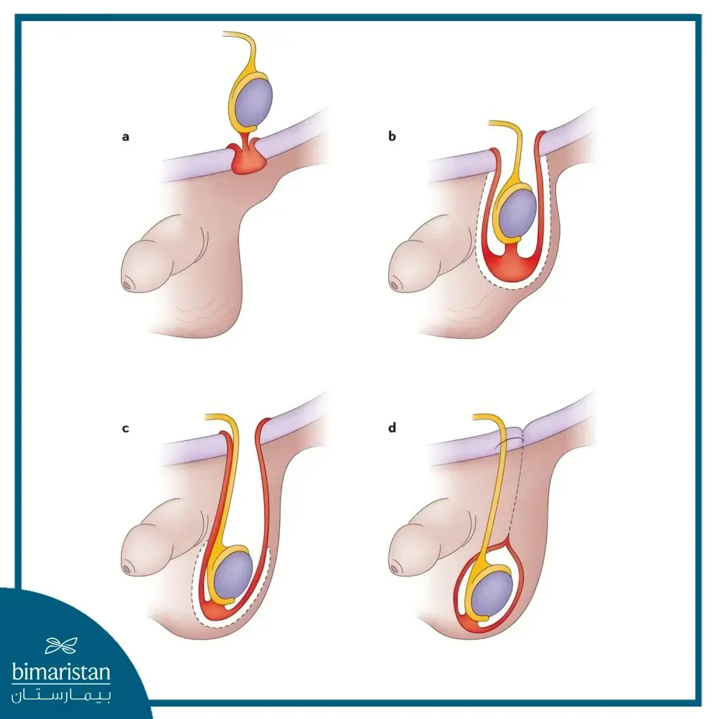 خطوات عملية الخصية المعلقة