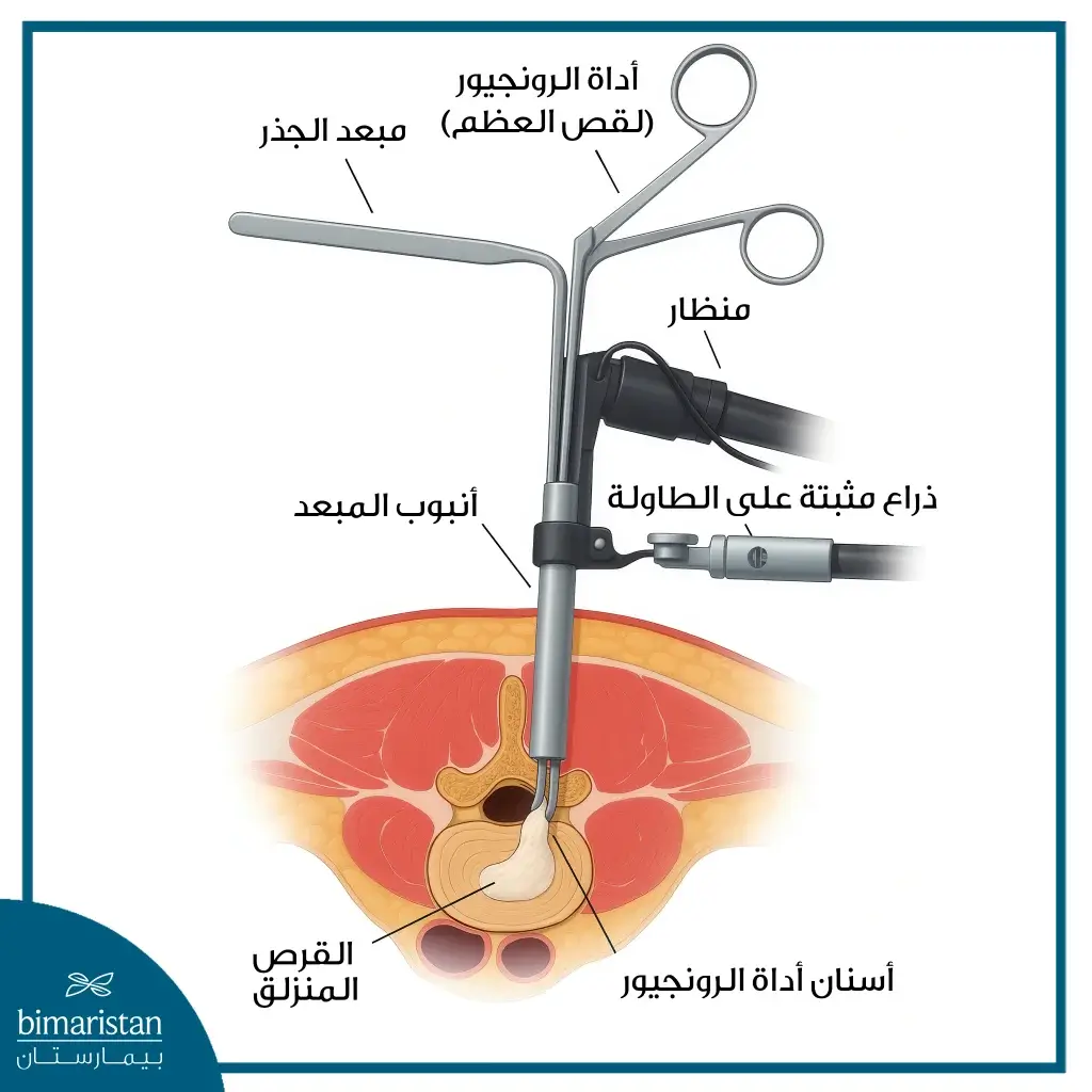 صورة توضح الآلية العامة للمنظار المستخدم في علاج الانزلاق الغضروفي
