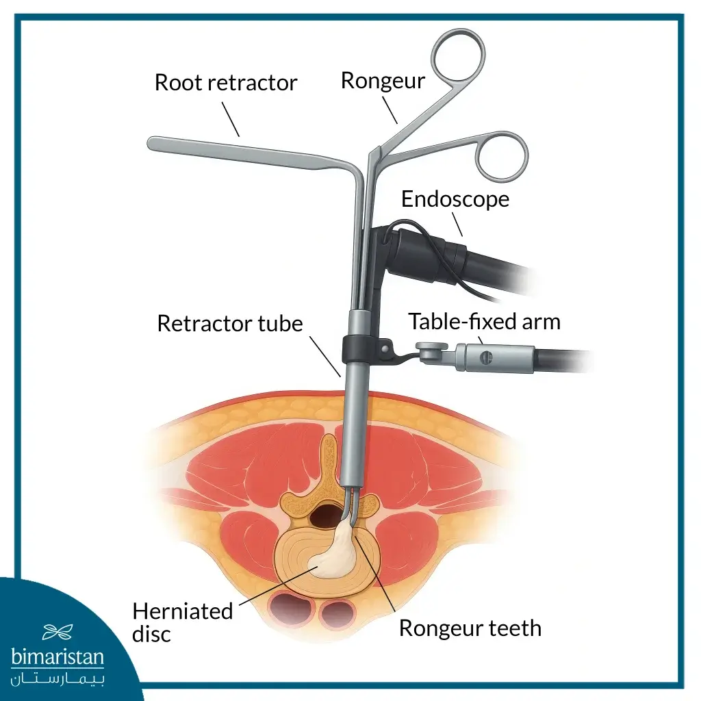 An Image Showing The General Mechanism Of The Arthroscope Used In Endoscopic Spine Surgery For Herniated Discs.