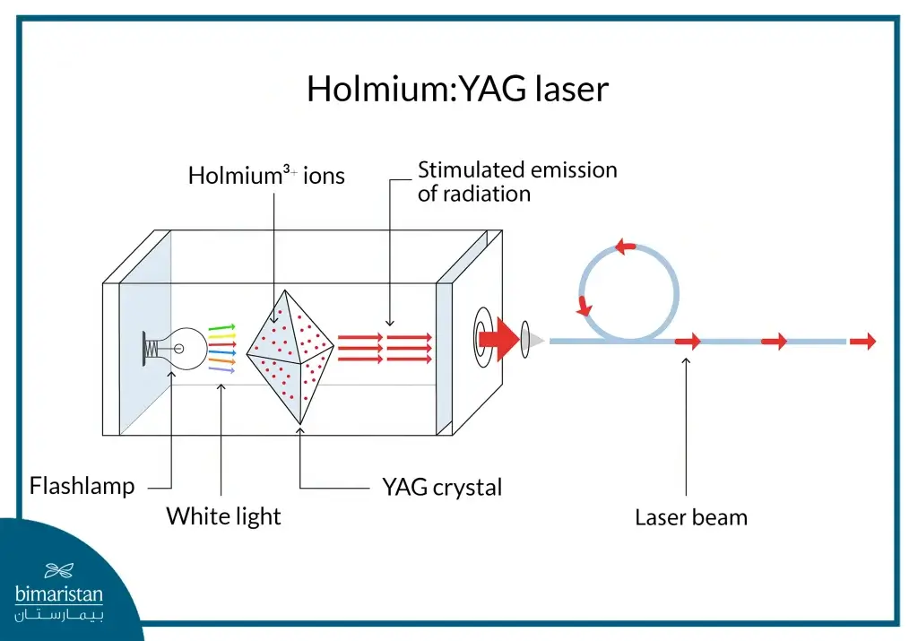 Holmium Urinary Stones Laser Surgery Is A Precise And Effective Technique For Treating Urinary Stones, Offering High Success Rates And Minimal Complications.