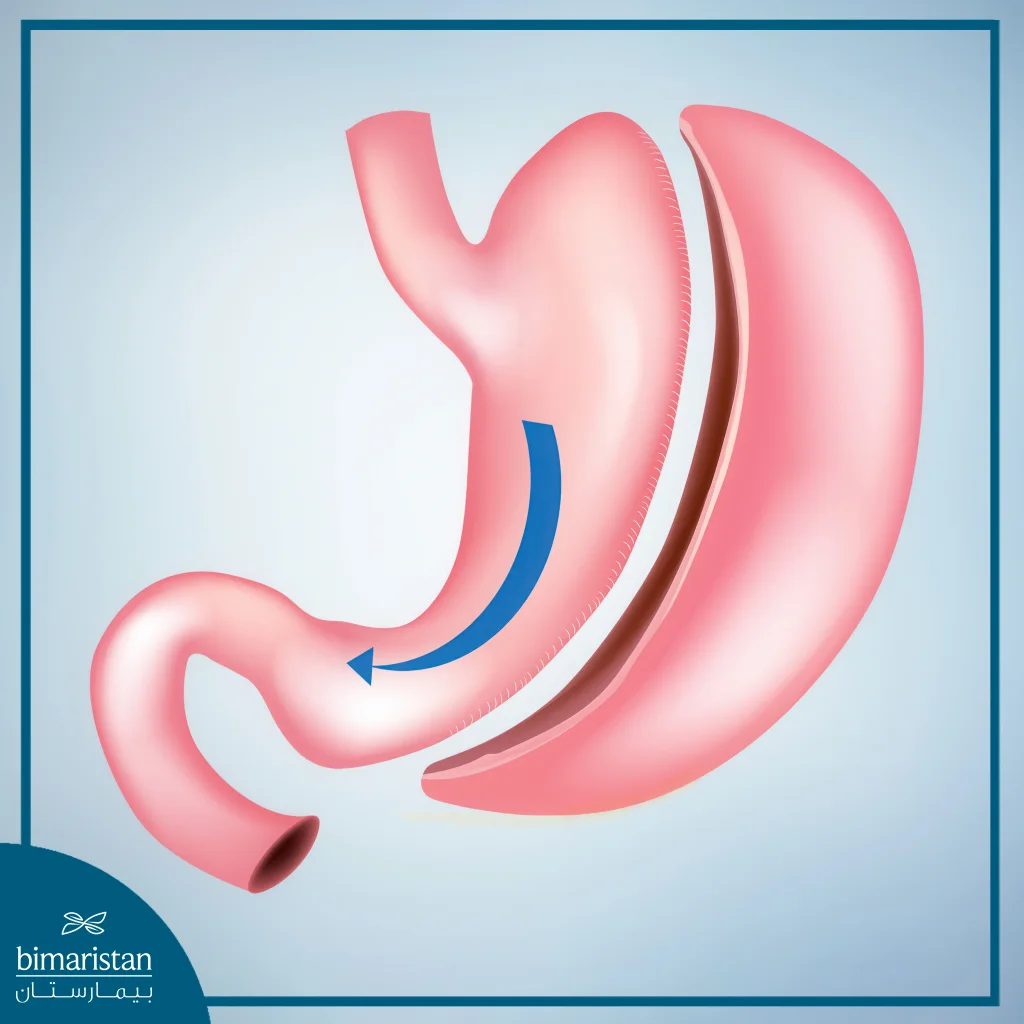 Bariatric Surgery And Fertility: How Weight Loss Surgery Affects Reproductive Health 3 Sleeve Gastrectomy Is A Form Of Bariatric Surgery And Fertility