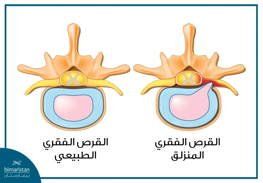 جراحة العمود الفقري بالمنظار: دليل شامل ومفصل 11 الانزلاق الغضروفي أحد استطبابات جراحة العمود الفقري بالمنظار