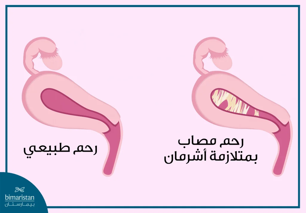 حقن المبيض بالخلايا الجذعية | أحدث علاج للعقم في تركيا 2025 3 صورة توضيحية لرحم مصاب بمتلازمة أشرمان