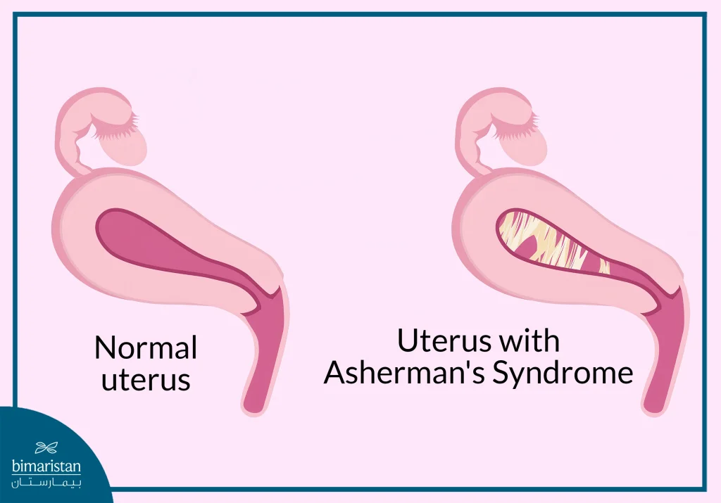 Illustration Of A Uterus With Asherman'S Syndrome