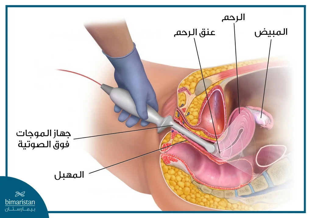 حقن المبيض بالخلايا الجذعية | أحدث علاج للعقم في تركيا 2025 2 سونار المهبل أحد طرق حقن المبيض بالخلايا الجذعية