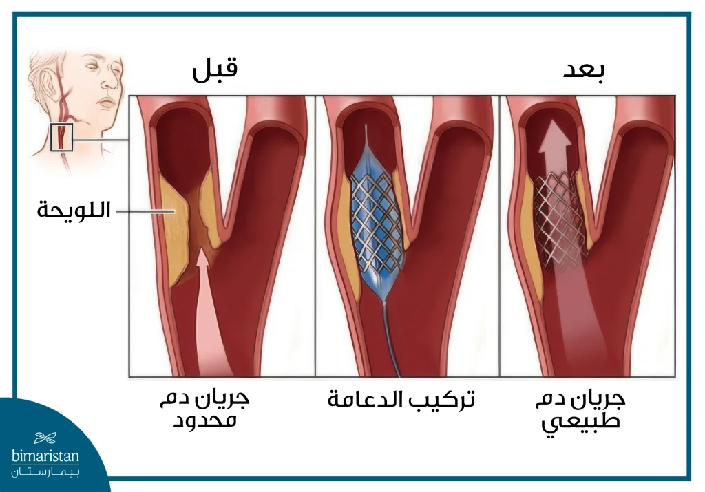 صورة توضح جريان الدم في الشريان السباتي قبل وبعد تركيب الدعامة
