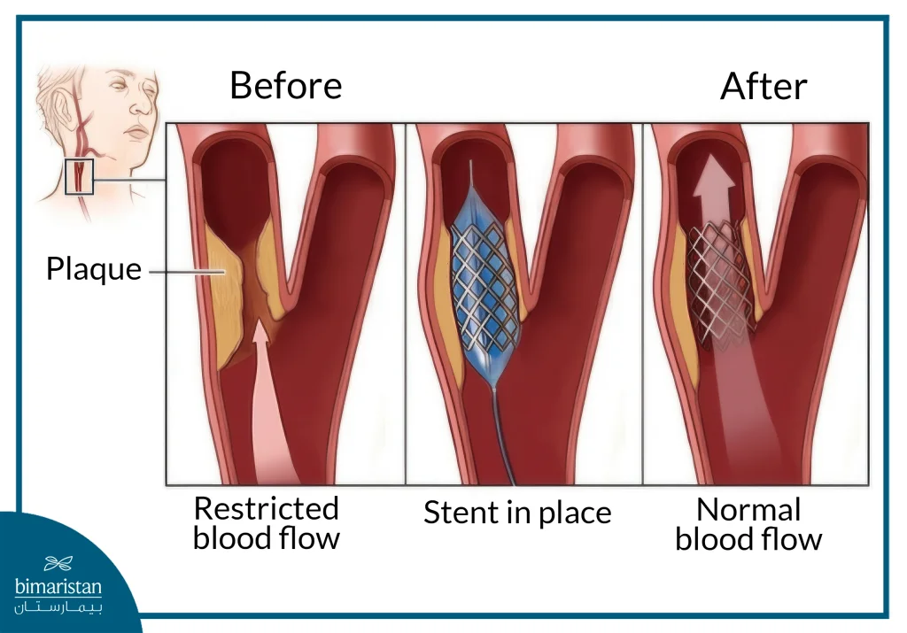 An Image Showing Blood Flow In The Carotid Artery Before And After Stent Placement