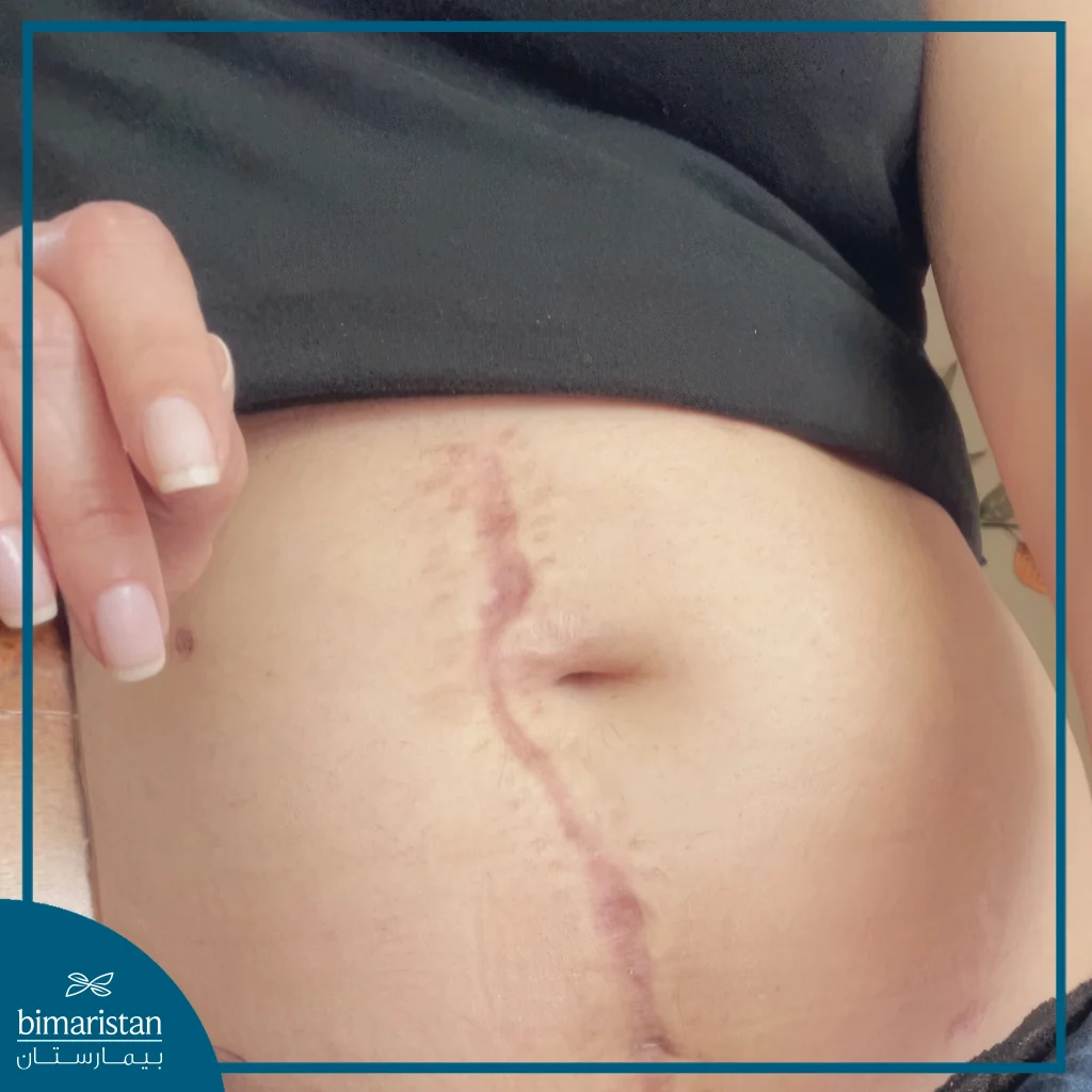 Image Showing The Incision For A Pancreas Transplant