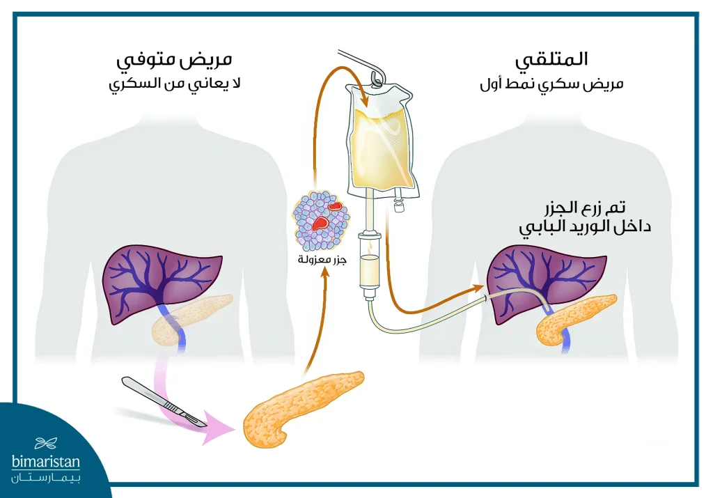 صورة توضح زراعة البنكرياس عن طريق الخلايا الجزيرية