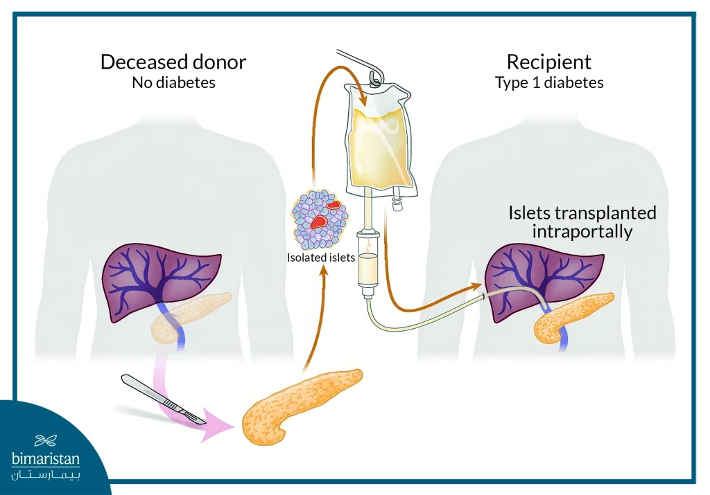 Pancreas Transplant With Islet Cells