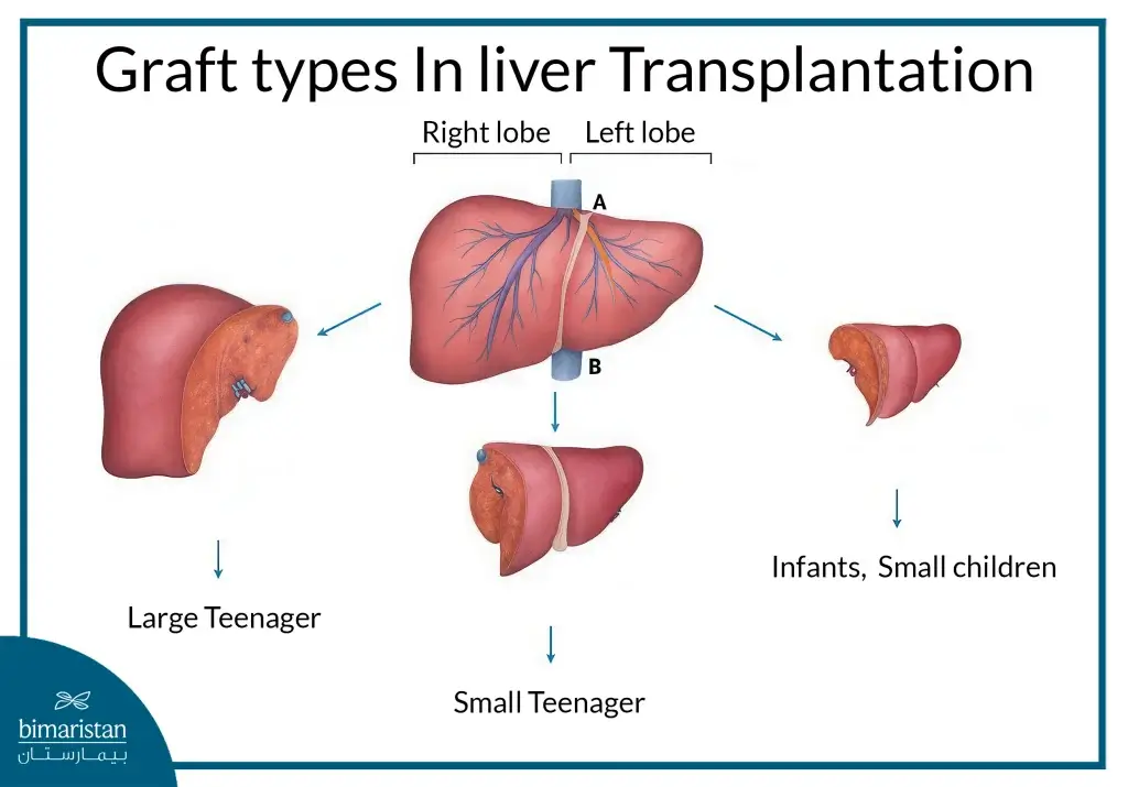 Liver Transplant For Children: An Image Showing The Different Types Of The Procedure